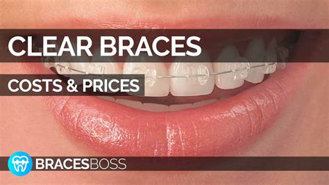 clear braces leatherhead|Clear Braces Cost, Types, Reviews: Complete Guide.